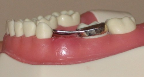 A Dental Space Maintainer - Spacer